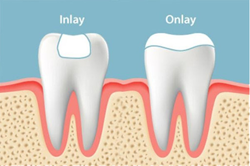 Two images - Inlay and Onlay